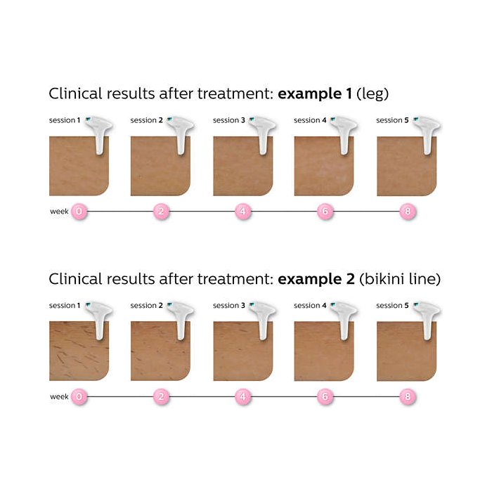 Philips Lumea Advanced IPL SC1997/00